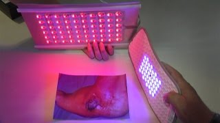 Medilight  Lichttherapie gegen chronische Wunden [upl. by Regnij]