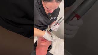 Genius Radiofrequency Microneedling [upl. by Mcallister]