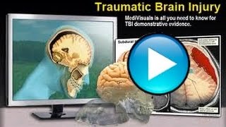 Footage of a real TBI Patients recovery using Glutathione Nebulization and Functional Neurology [upl. by Stephenson347]