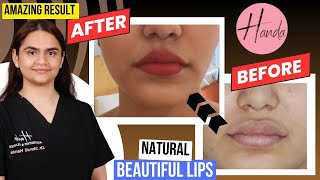 Fixing Botched Lip Fillers  Real Life Plastic Surgery Transformation [upl. by Spense]