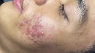 ACNE TREATMENT VU QUYNH MI  Blackheads Of Tweens 2024 EX [upl. by Wittenburg]