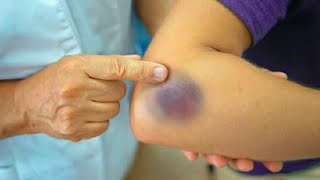 What is HematomaWhy it occurs after blood drawCauses and preventions of hematoma yellowish green [upl. by Auberon]