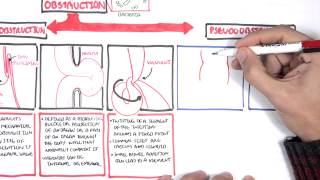 Bowel Obstruction  Causes and Pathophysiology [upl. by Pappas705]