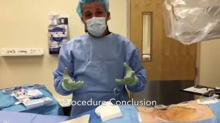 Spinal Cord Stimulator Trial Performed By Eduard Vaynberg MD [upl. by Ataner380]