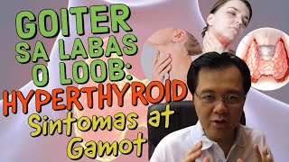 Goiter sa Labas o Loob Hyperthyroid Sintomas at Gamot  Payo ni Doc Willie Ong 212 [upl. by Nyladnarb]