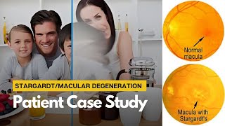 Stargardt amp Macular Degeneration Treatment  Treatment for Centre Vision Loss  Patient Cast Study [upl. by Milty]