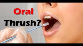 How To Cure Oral Thrush Fast In Babies And Adults Natural Remedies [upl. by Libys826]