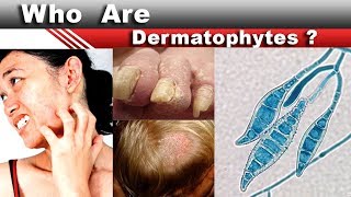 Who are dermatophytes [upl. by Gilli]