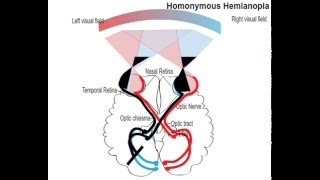 homonemous hemianopia [upl. by Astrea]