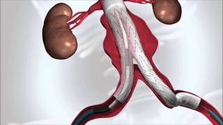 Abdominal Aortic Aneurysm [upl. by Rossner]