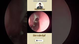 귀지형 콧물 부비동염 축농증 비염 코청소 이비인후과 rhinorrhea rhinitis sinusitis asmr ENT entdoctor [upl. by Enaasiali]