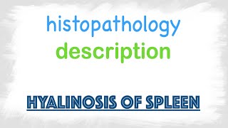 Hyalinosis of Spleen Histopathology [upl. by Norak683]