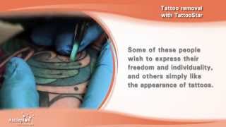 Tattoo removal with the TattooStar qswitched laser by Asclepion [upl. by Anekam]