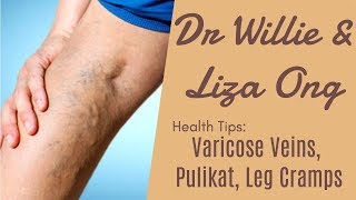 Varicose Veins Pulikat Leg Cramps  ni Doc Willie at Liza Ong 418 [upl. by Roz]