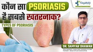 Psoriasis कितने तरह के होते हैं कैसे होगा इनका इलाज  Psoriasis Treatment India [upl. by Atneuqal]