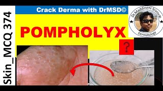 Dyshidrotic Eczema  POMPHOLYX  Causes Symptoms Diagnosis amp Treatment by Dr Maddineni Srinivas [upl. by Burroughs]