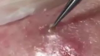 Deep BLACKHEAD Removal on Cheeks  Cystic Acne Treatment [upl. by Brodeur897]