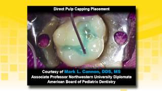 TheraCal LC as a Liner in a Class II Resin Based Composite Restoration [upl. by Adleremse]