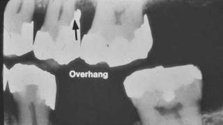 Dental Radiograph Pathology amp Restorations  Part I [upl. by Lecia598]