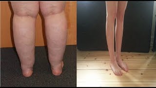 how to get rid of cankles without surgery [upl. by Assirrac]