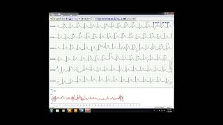 Analysis For HOLTER 48 Hours Software In English By Eng Mohamed El Ashry [upl. by Otilia108]