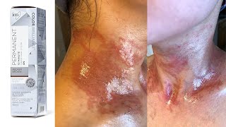 Sallys Hair Dye Allergic Reaction  How I Dye My Hair With Henna Naturally And NO Chemicals [upl. by Valery]