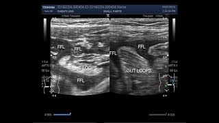 Ultrasound Video showing Intestinal obstruction with perforation [upl. by Anala]