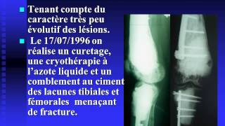 Hémangioendothéliome épithélioïde multifocal du membre inférieur [upl. by Lomasi]