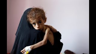 Fighting starvation and disease yield grim crisis in Yemen [upl. by Kalli]