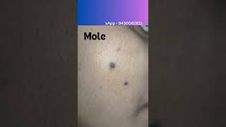 Mole removal surgery Laser mole removal scarless mole removal shorts youtubeshorts [upl. by Esinereb]