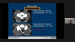 Unilateral hemilaminectomy for bilateral decompression in cervical spondylotic myelopathy [upl. by Guadalupe778]