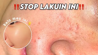 Jerawat Makin Parah  kesalahan skincare utk oily amp acne prone skin [upl. by Brick6]