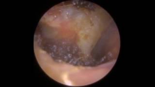 Delicately peeling ear wax off eardrum and anterior recess  Mr Neel Raithatha The Hear Clinic [upl. by Sampson]