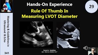 HandsOn Experience 29 Rule Of Thumb In Measuring LVOT Diameter [upl. by Assirahc991]