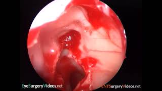 Endoscopic medial wall orbital decompression [upl. by Sikleb142]