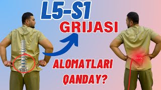 L5S1 grijasi alomatlari [upl. by Nwahsir]