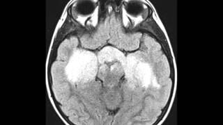 Optic Pathway Glioma [upl. by Jarin]