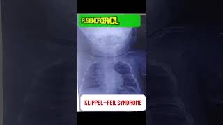 KlippelFeil Syndrome  Congenital Musculoskeletal Disorder medicalstudent mbbs doctor [upl. by Venita]