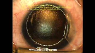 LASIK surgery explained stepbystep by Shannon Wong MD 122111 [upl. by Map]