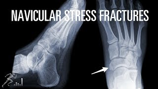 How can you quickly recover from a navicular stress fracture [upl. by Eudoxia]