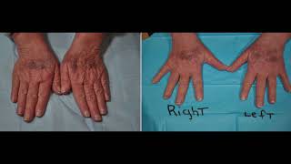 Sculptra for Crepey Skin of the Hands Arms and Neck [upl. by Nywloc643]