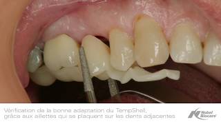 Cas clinique du Dr Roland Glauser  Pose dune TempShell [upl. by Emirac]