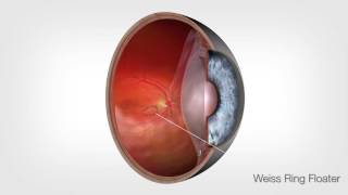 Vitreolysis Animation HD [upl. by Letrice202]