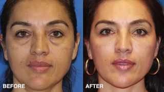 Facial Plastic Surgeon Explains How to Take 10 Years off your Eyes With Surgery blepharoplasty [upl. by Danella]