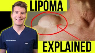 Doctor explains LIPOMA  Symptoms clinical photos and treatment [upl. by Ajidahk]