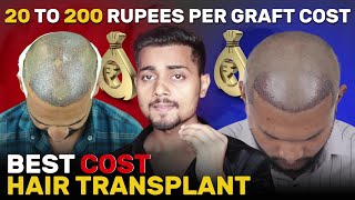 Cost Of Hair Transplant In India  Hair Transplant mein Kitna Kharcha Hota Hai [upl. by Annetta185]