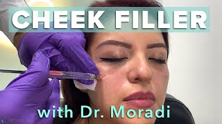 Watch This Patient Get Cheek Filler Before amp After Restylane Contour [upl. by Maffa86]