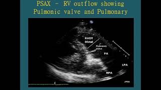 Normal Views  Transthoracic Echocardiogram TTE [upl. by Yablon]