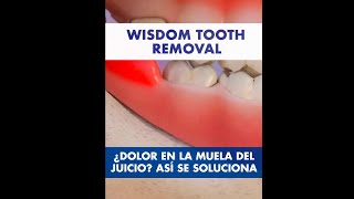 Por esto DUELE la MUELA del JUICIO y así se SACA  Pericoronaritis y extracción de los cordales © [upl. by Ernesto660]