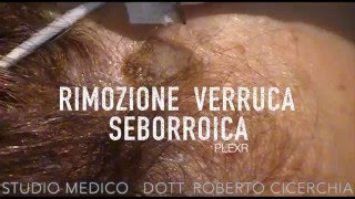 Rimozione Cheratosi con PLEXR  Dott Roberto Cicerchia [upl. by Lalita]